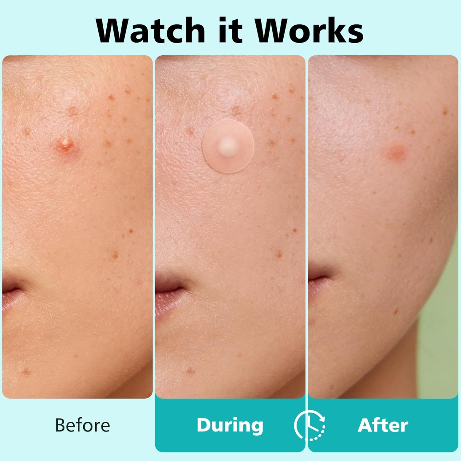 ClearSkin Pimple Patches
