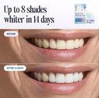 BrightSmile Enzyme Whitening Strips